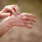 Close,Up,Dermatitis,On,Skin,,Ill,Allergic,Rash,Eczema,Skin