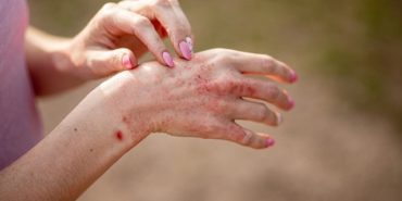 Close,Up,Dermatitis,On,Skin,,Ill,Allergic,Rash,Eczema,Skin