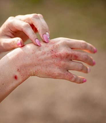 Close,Up,Dermatitis,On,Skin,,Ill,Allergic,Rash,Eczema,Skin